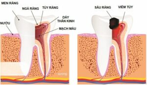 Viêm tuỷ răng