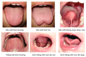 Dấu hiệu khi trẻ dính thắng lưỡi