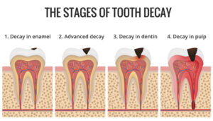 Các giai đoạn của sâu răng