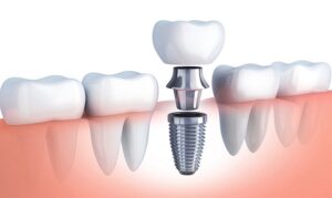 Implant là cách khắc phục tình trạng mất răng hiệu quả nhất