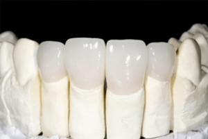 Giá bọc răng sứ Venus tại Emera Dental