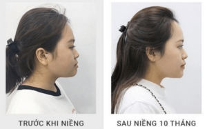 Niềng răng khiến gương mặt có đường nét hài hoà hơn