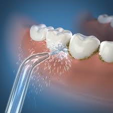 Cách điều trị mảng bám đen trên răng hiệu quả