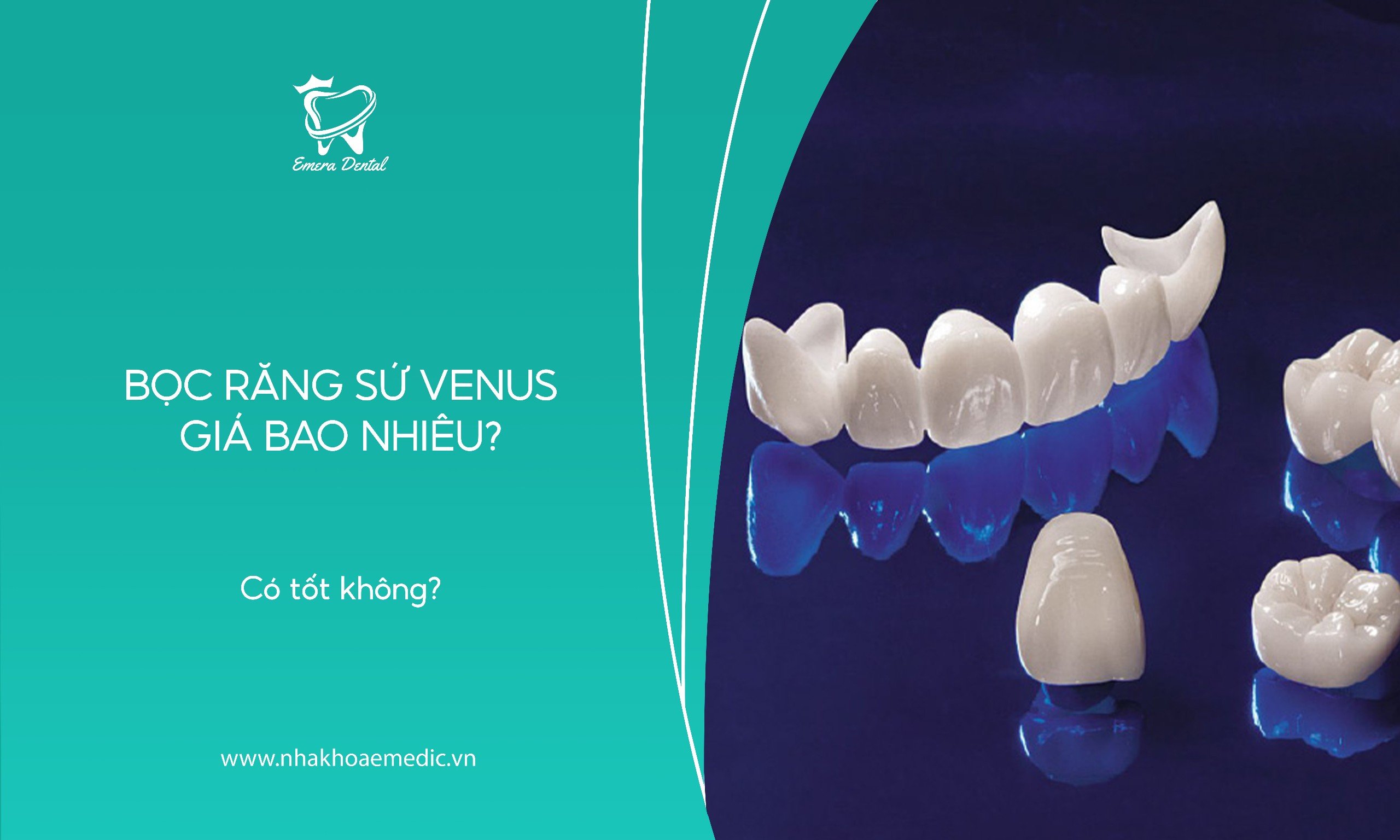 Bọc răng sứ Venus giá bao nhiêu? Có tốt không?