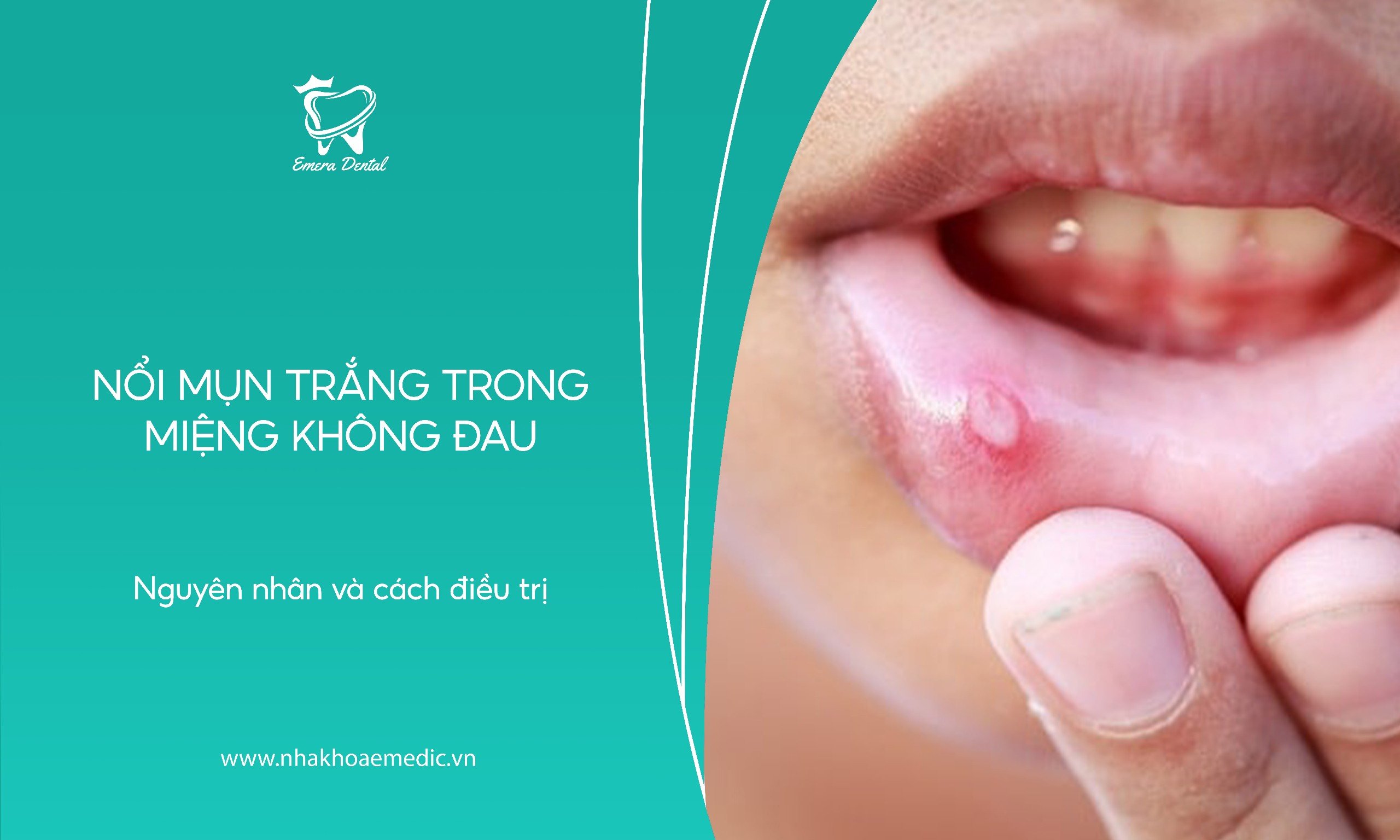 Nổi mụn trắng trong miệng không đau: Nguyên nhân và cách điều