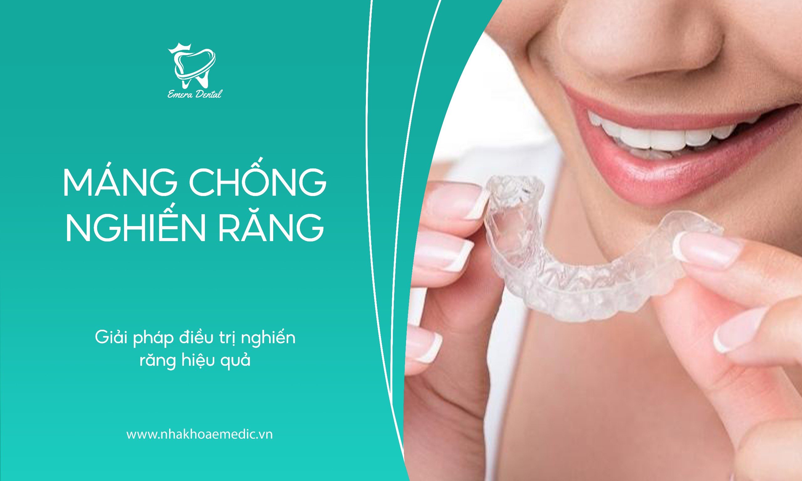 Máng chống nghiến răng – Giải pháp điều trị nghiến răng an toàn hiệu quả