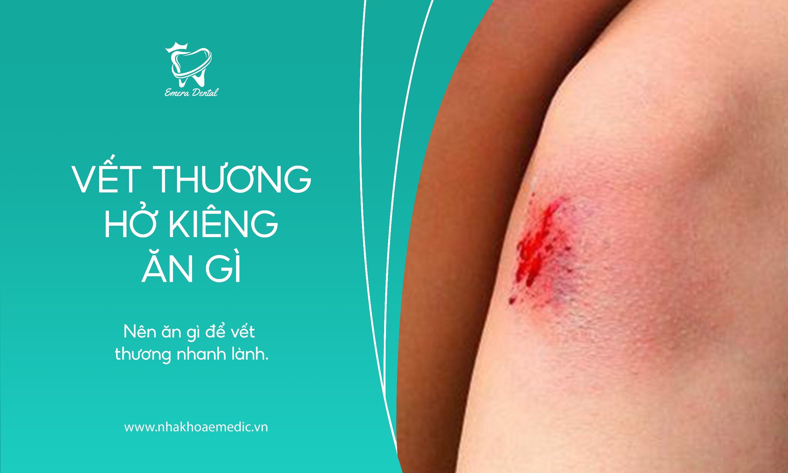 Vết thương hở kiêng ăn gì, nên ăn gì để vết thương nhanh lành