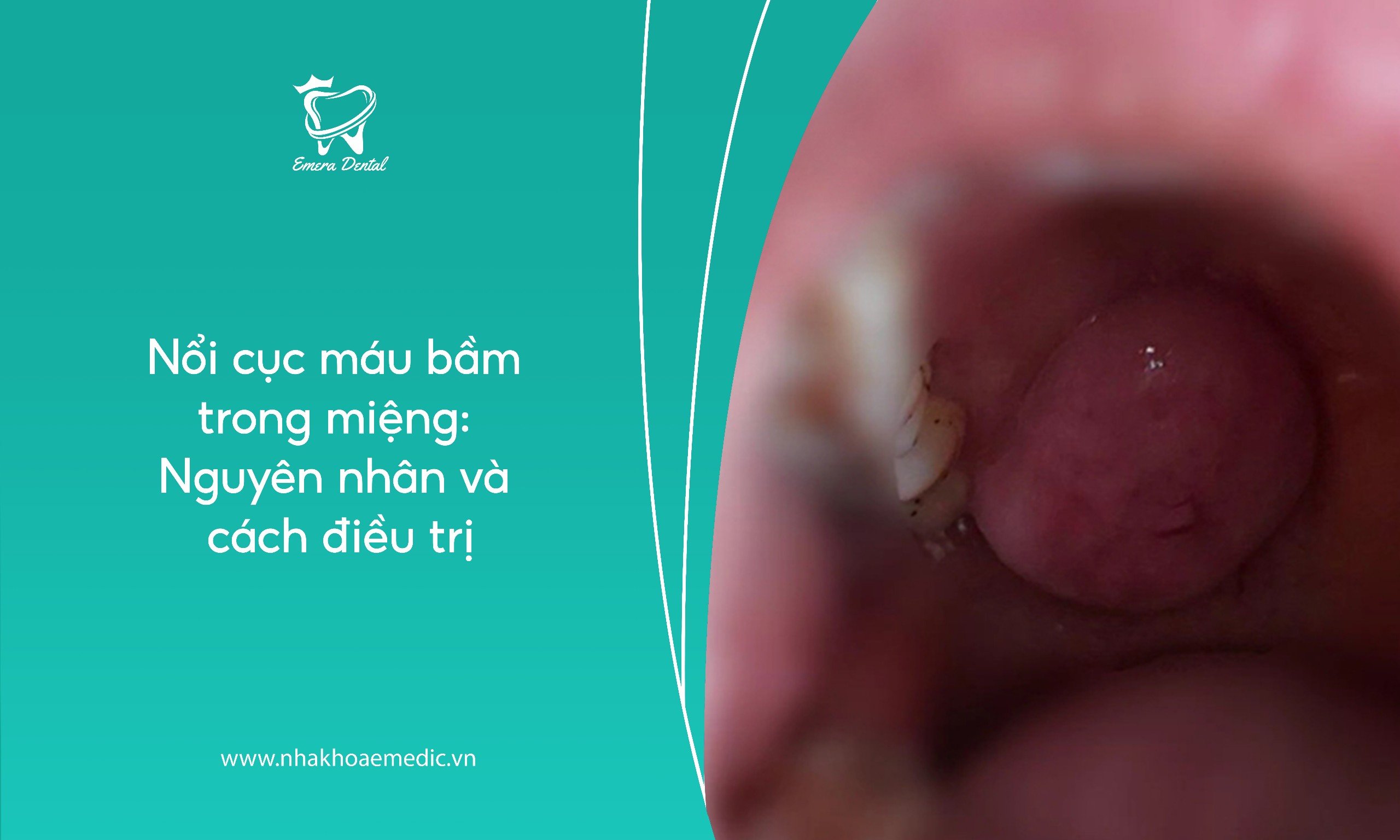 Nổi cục máu bầm trong miệng: Nguyên nhân và cách điều trị