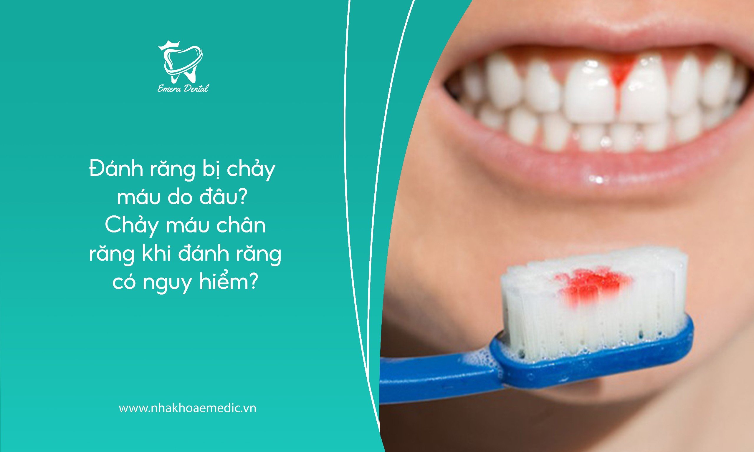 Đánh răng bị chảy máu do đâu? Chảy máu chân răng khi đánh răng có nguy hiểm?