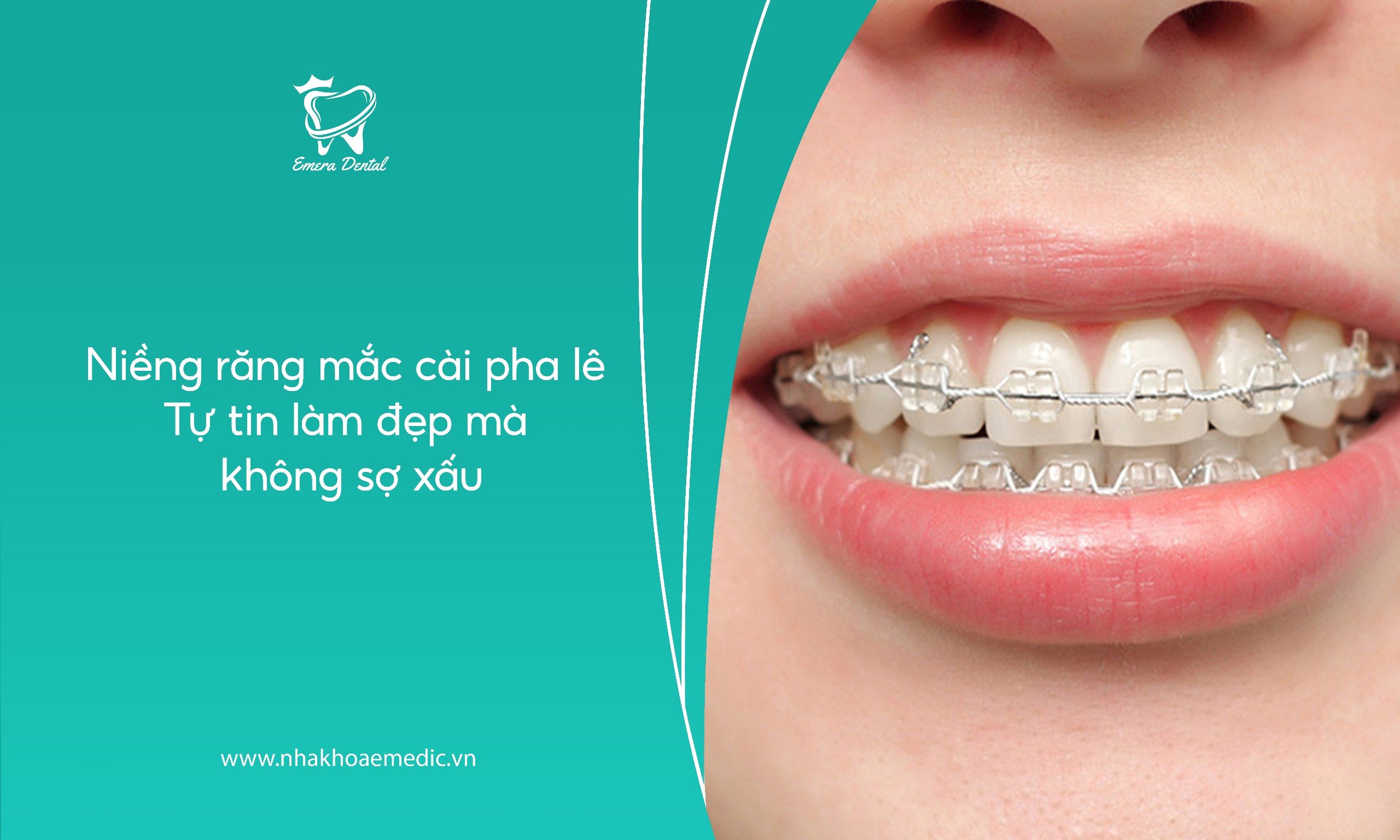 Niềng răng mắc cài pha lê – Tự tin làm đẹp mà không sợ xấu