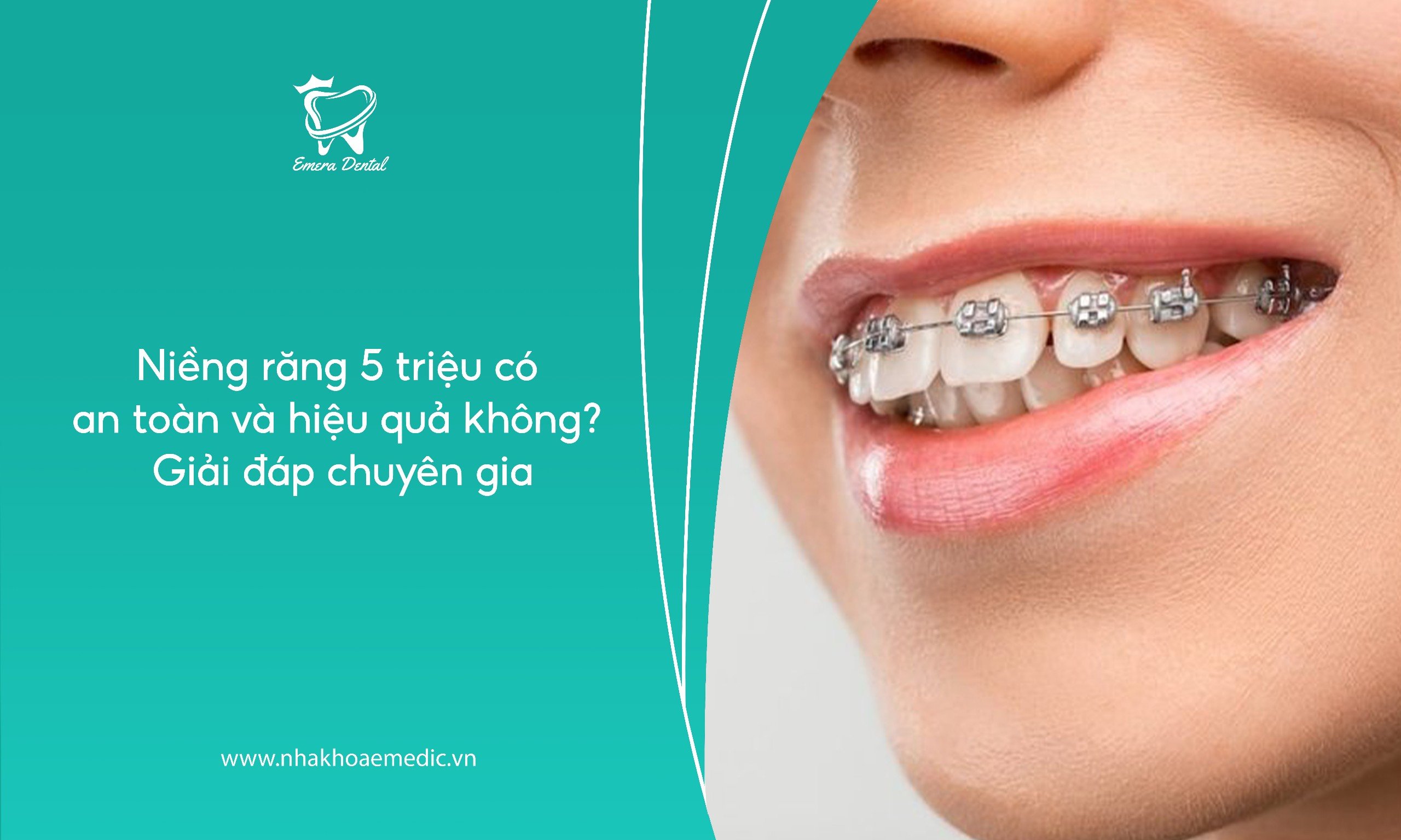 Niềng răng 5 triệu có an toàn và hiệu quả không? Giải đáp chuyên gia